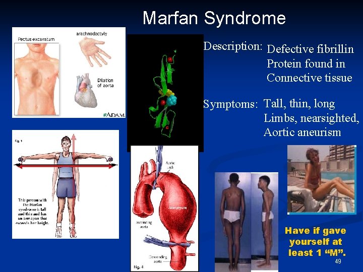 Marfan Syndrome Description: Defective fibrillin Protein found in Connective tissue Symptoms: Tall, thin, long