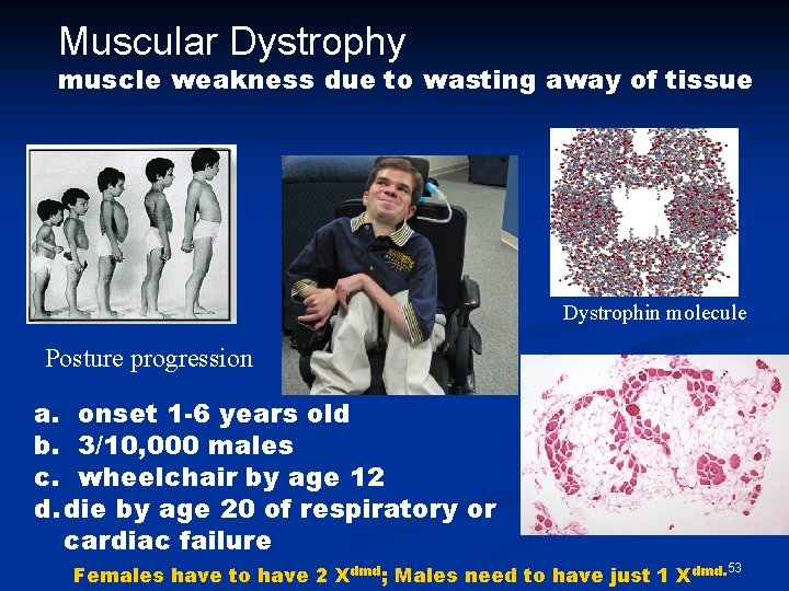 Muscular Dystrophy muscle weakness due to wasting away of tissue Dystrophin molecule Posture progression