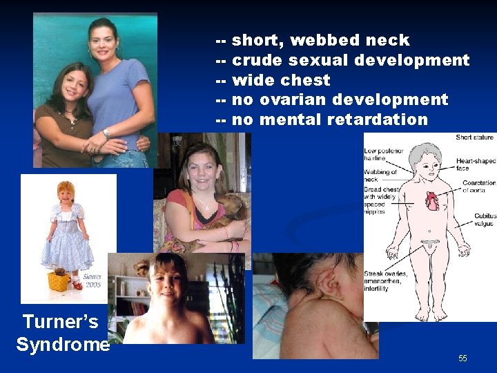 ------ Turner’s Syndrome short, webbed neck crude sexual development wide chest no ovarian development