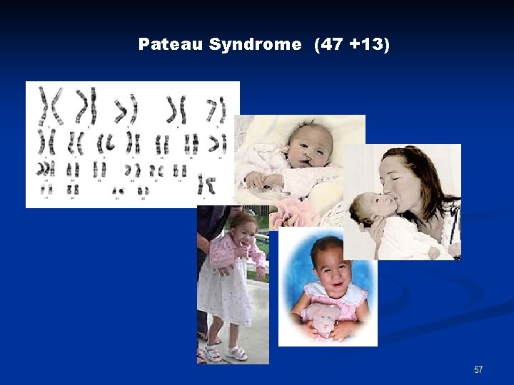 Pateau Syndrome (47 +13) 57 