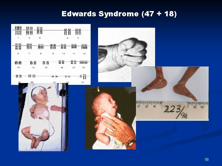 Edwards Syndrome (47 + 18) 58 