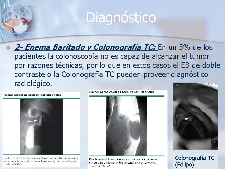 Diagnóstico n 2 - Enema Baritado y Colonografía TC: En un 5% de los