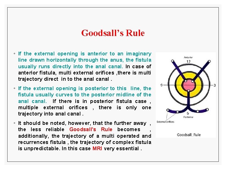 Goodsall’s Rule ◦ If the external opening is anterior to an imaginary line drawn