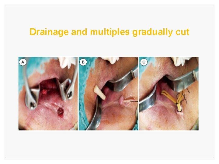 Drainage and multiples gradually cut 