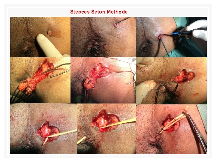 Stepces Seton Methode 