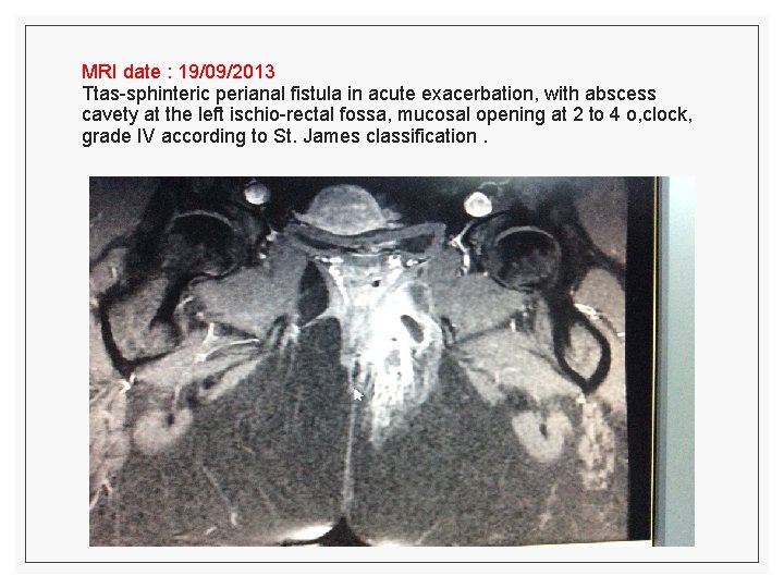 MRI date : 19/09/2013 Ttas-sphinteric perianal fistula in acute exacerbation, with abscess cavety at