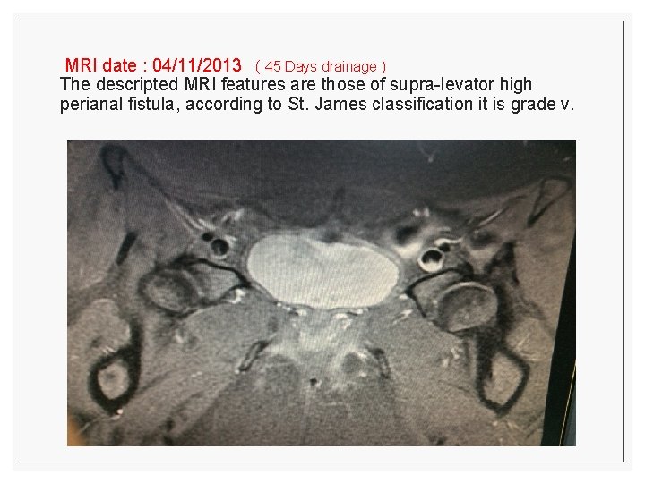 MRI date : 04/11/2013 ( 45 Days drainage ) The descripted MRI features are