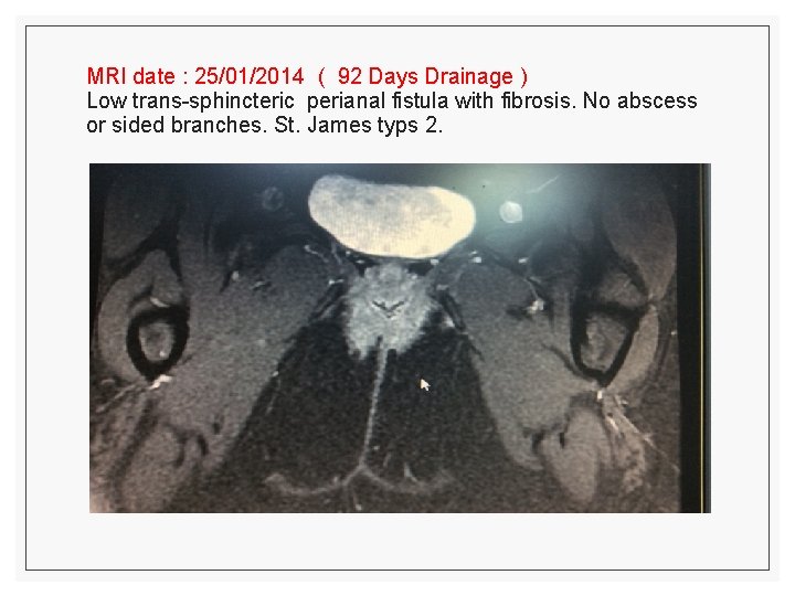 MRI date : 25/01/2014 ( 92 Days Drainage ) Low trans-sphincteric perianal fistula with