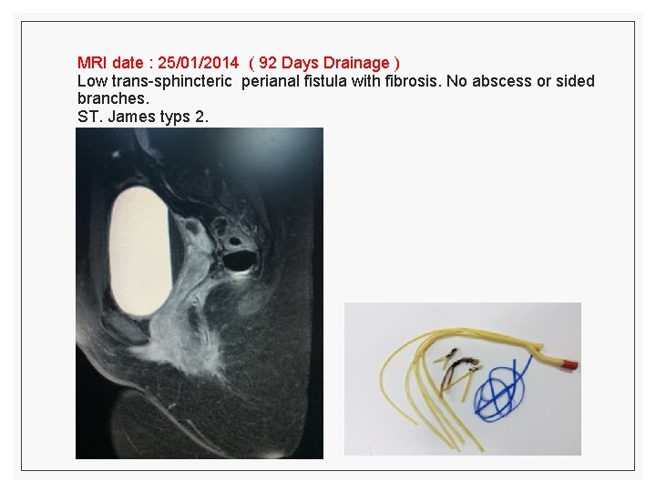 MRI date : 25/01/2014 ( 92 Days Drainage ) Low trans-sphincteric perianal fistula with