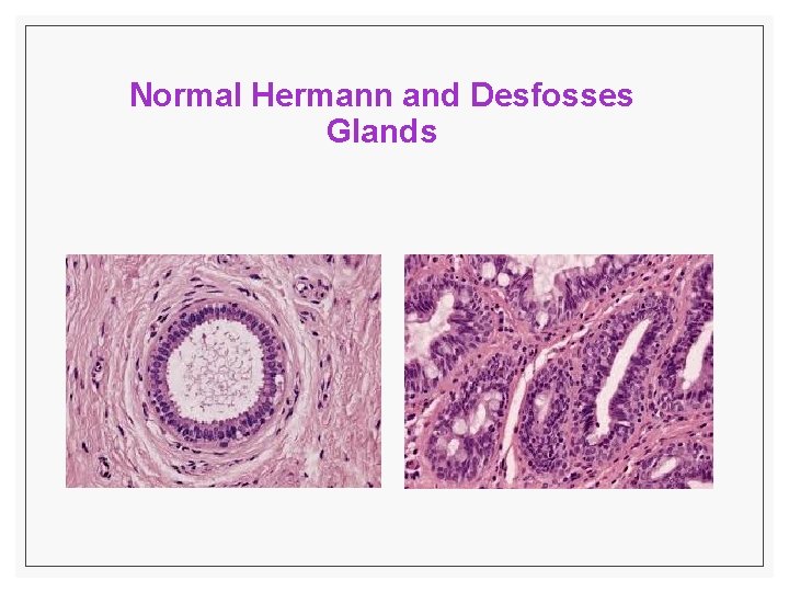 Normal Hermann and Desfosses Glands 