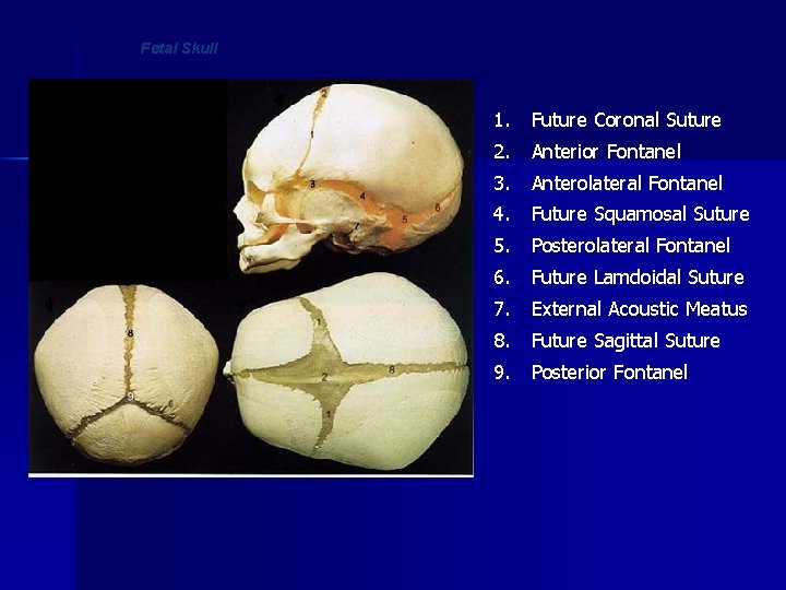 Fetal Skull 1. Future Coronal Suture 2. Anterior Fontanel 3. Anterolateral Fontanel 4. Future