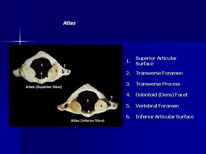 Atlas 1. Superior Articular Surface 2. Transverse Foramen 3. Transverse Process 4. Odontoid (Dens)