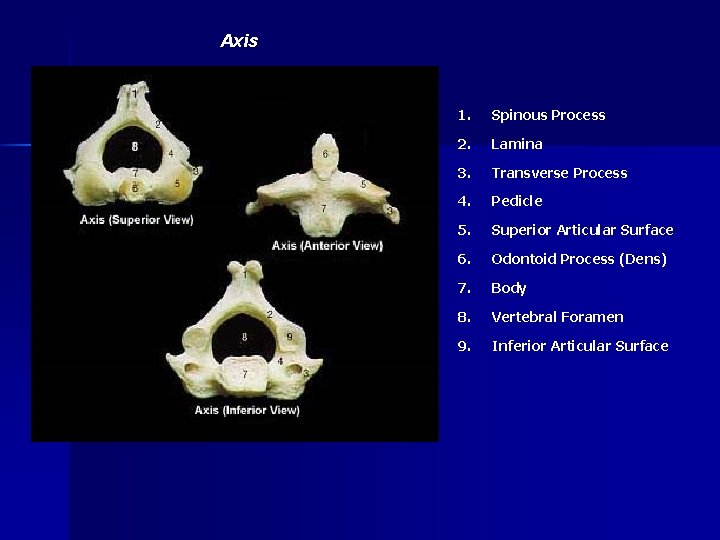 Axis 1. Spinous Process 2. Lamina 3. Transverse Process 4. Pedicle 5. Superior Articular