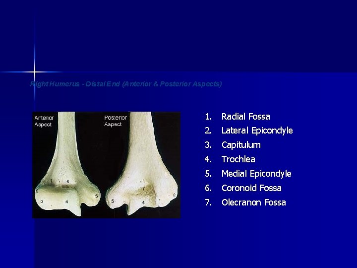 Right Humerus - Distal End (Anterior & Posterior Aspects) 1. Radial Fossa 2. Lateral