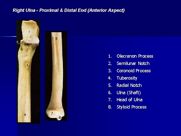 Right Ulna - Proximal & Distal End (Anterior Aspect) 1. Olecranon Process 2. Semilunar