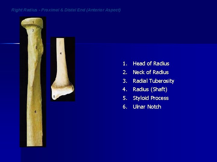 Right Radius - Proximal & Distal End (Anterior Aspect) 1. Head of Radius 2.