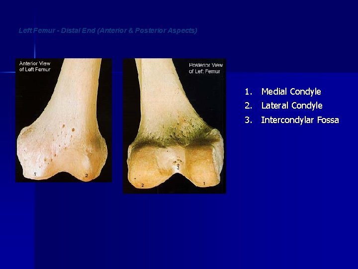 Left Femur - Distal End (Anterior & Posterior Aspects) 1. Medial Condyle 2. Lateral
