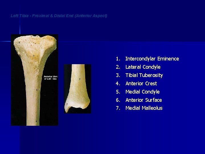 Left Tibia - Proximal & Distal End (Anterior Aspect) 1. Intercondylar Eminence 2. Lateral