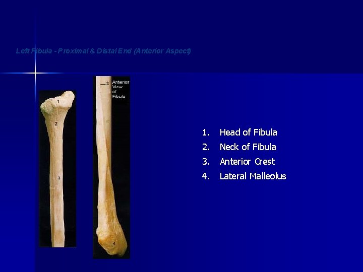 Left Fibula - Proximal & Distal End (Anterior Aspect) 1. Head of Fibula 2.
