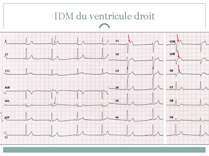 IDM du ventricule droit 