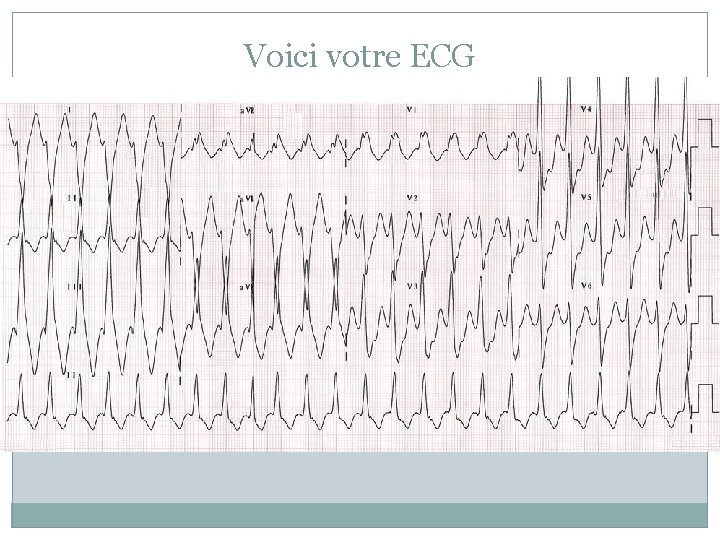 Voici votre ECG 
