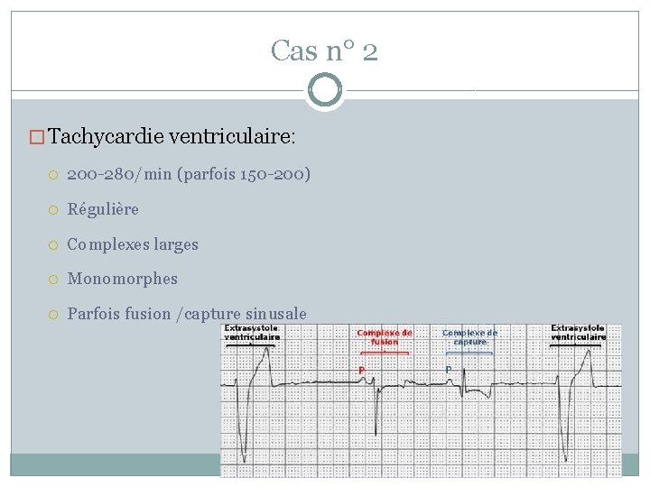 Cas n° 2 � Tachycardie ventriculaire: 200 -280/min (parfois 150 -200) Régulière Complexes larges