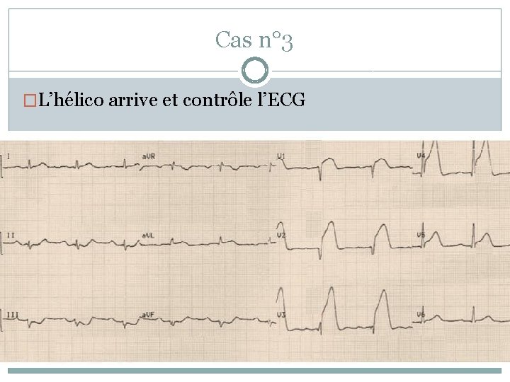 Cas n° 3 �L’hélico arrive et contrôle l’ECG 