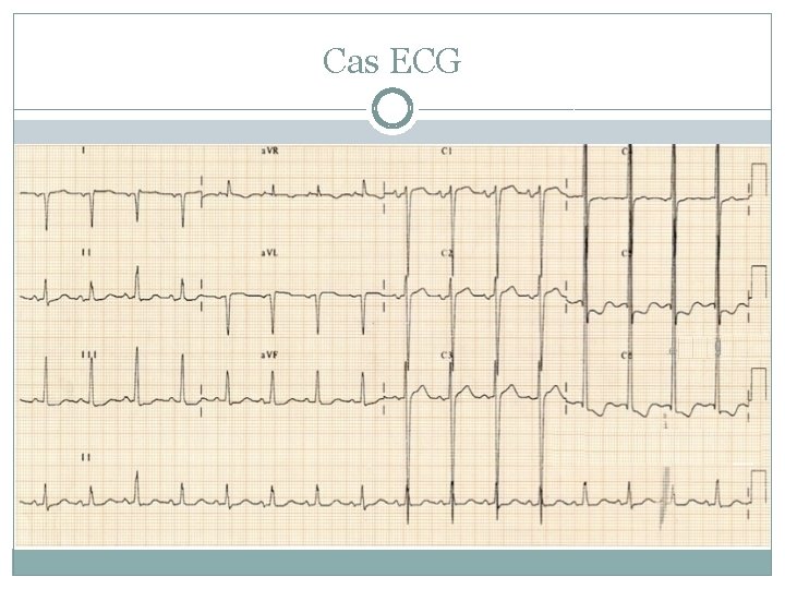 Cas ECG 