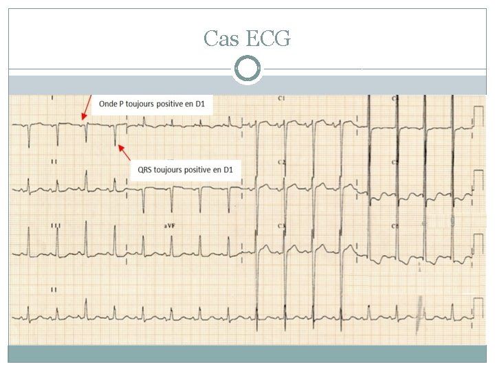 Cas ECG 