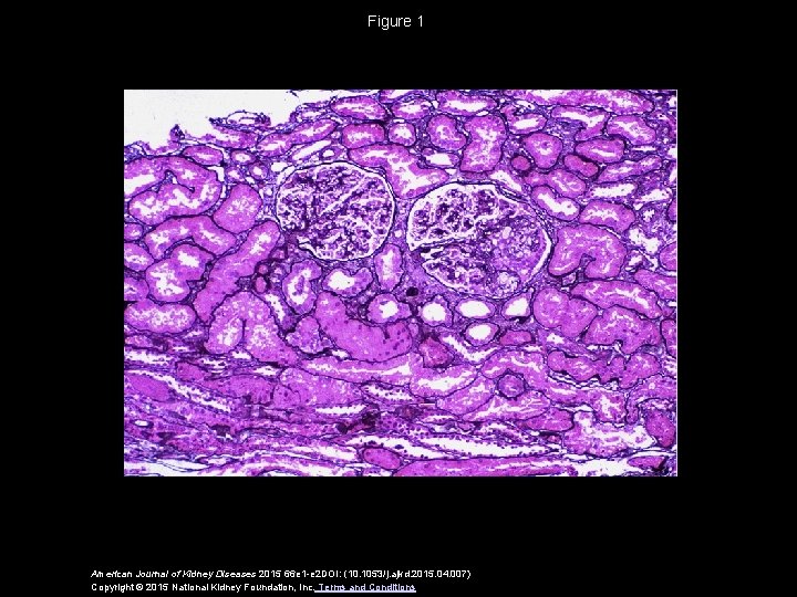 Figure 1 American Journal of Kidney Diseases 2015 66 e 1 -e 2 DOI: