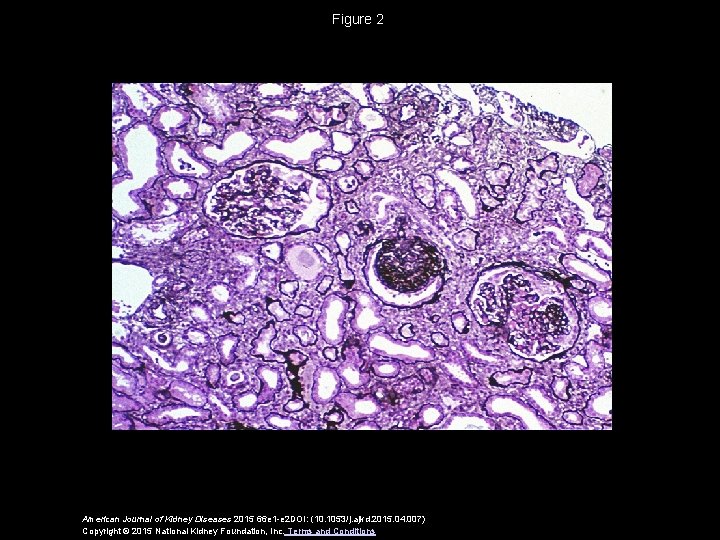 Figure 2 American Journal of Kidney Diseases 2015 66 e 1 -e 2 DOI: