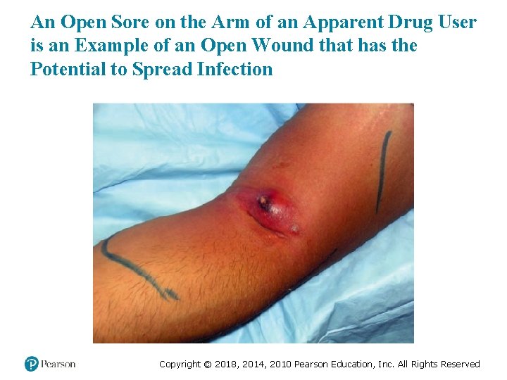 An Open Sore on the Arm of an Apparent Drug User is an Example