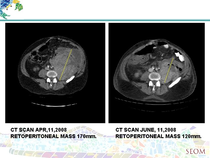 CT SCAN APR, 11, 2008 RETOPERITONEAL MASS 170 mm. CT SCAN JUNE, 11, 2008