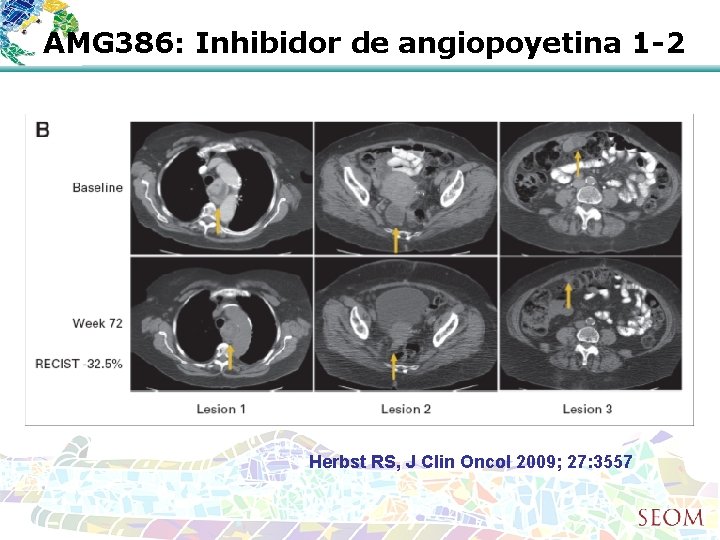 AMG 386: Inhibidor de angiopoyetina 1 -2 Herbst RS, J Clin Oncol 2009; 27: