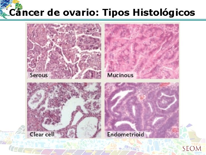 Cáncer de ovario: Tipos Histológicos 