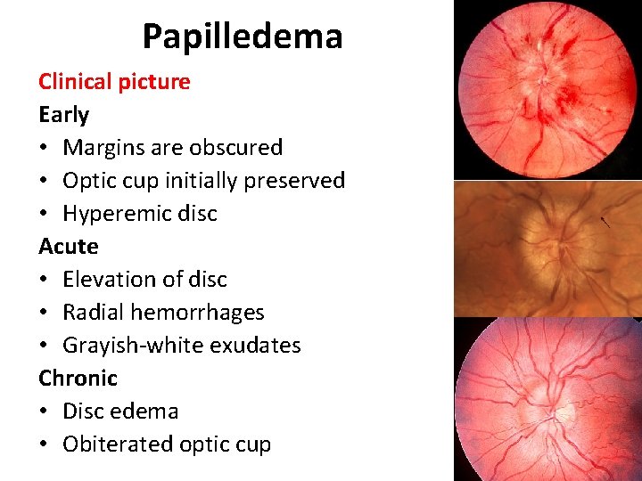 Papilledema Clinical picture Early • Margins are obscured • Optic cup initially preserved •