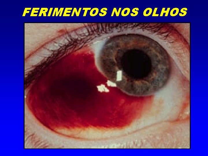 FERIMENTOS NOS OLHOS 