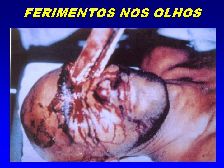 FERIMENTOS NOS OLHOS 