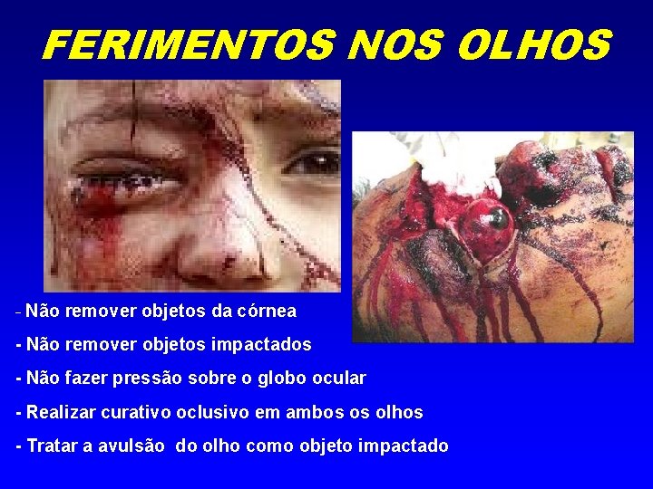 FERIMENTOS NOS OLHOS - Não remover objetos da córnea - Não remover objetos impactados