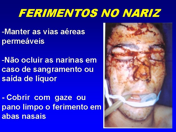 FERIMENTOS NO NARIZ -Manter as vias aéreas permeáveis -Não ocluir as narinas em caso