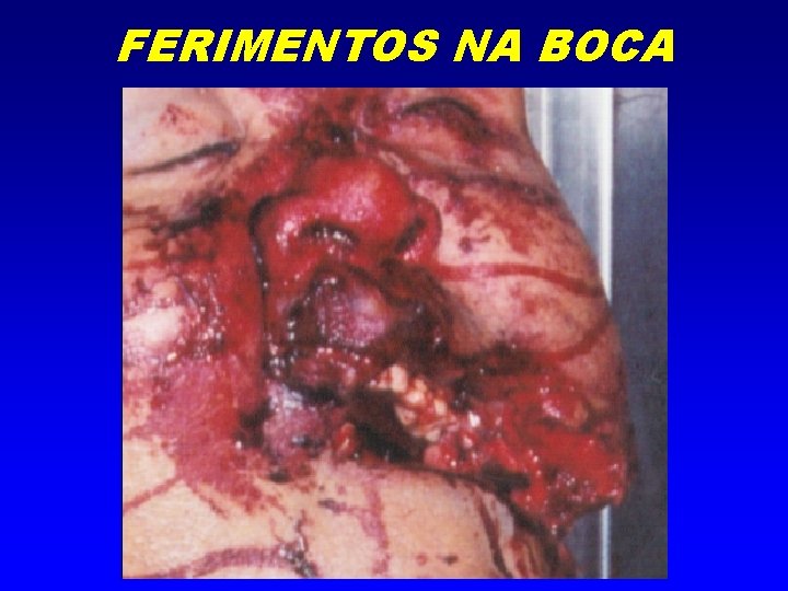 FERIMENTOS NA BOCA 