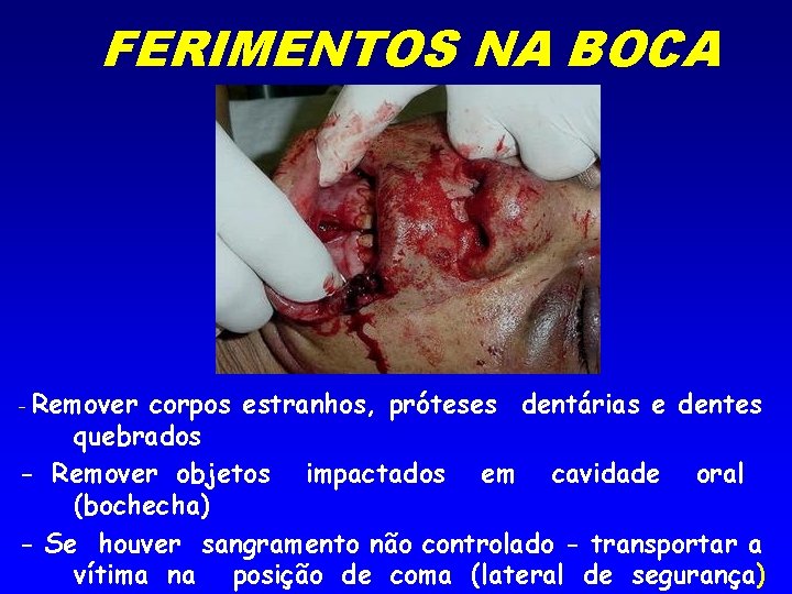 FERIMENTOS NA BOCA - Remover corpos estranhos, próteses dentárias e dentes quebrados - Remover