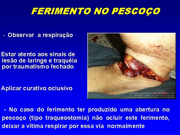FERIMENTO NO PESCOÇO - Observar a respiração Estar atento aos sinais de lesão de