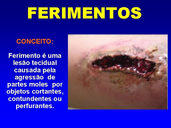 FERIMENTOS CONCEITO: Ferimento é uma lesão tecidual causada pela agressão de partes moles por