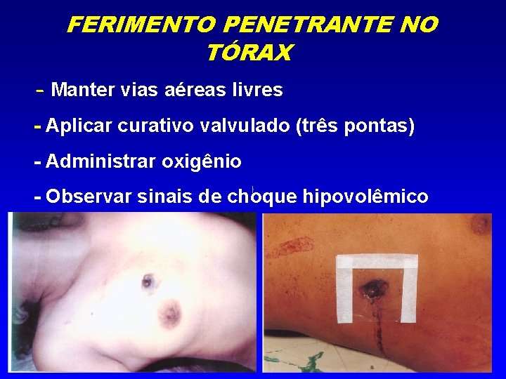 FERIMENTO PENETRANTE NO TÓRAX - Manter vias aéreas livres - Aplicar curativo valvulado (três