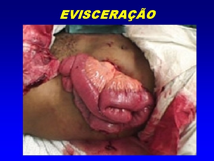 EVISCERAÇÃO 