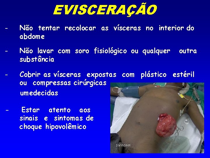 EVISCERAÇÃO - Não tentar recolocar as vísceras no interior do abdome - Não lavar