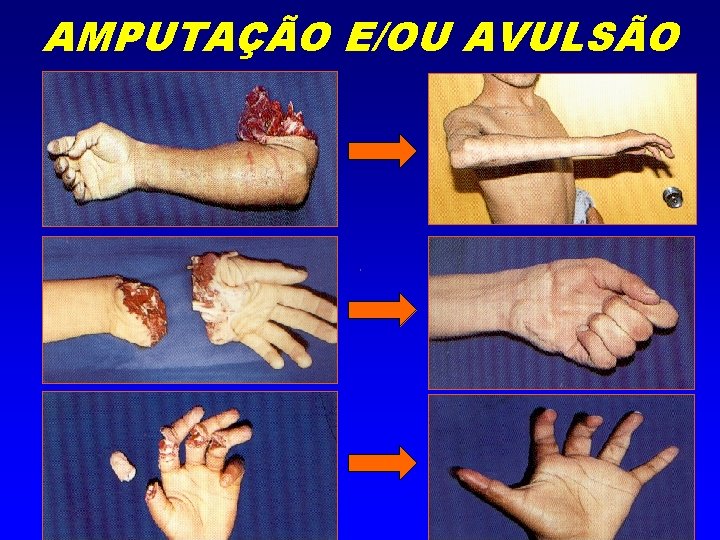 AMPUTAÇÃO E/OU AVULSÃO 