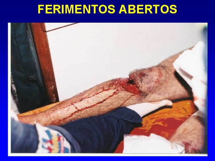 FERIMENTOS ABERTOS 