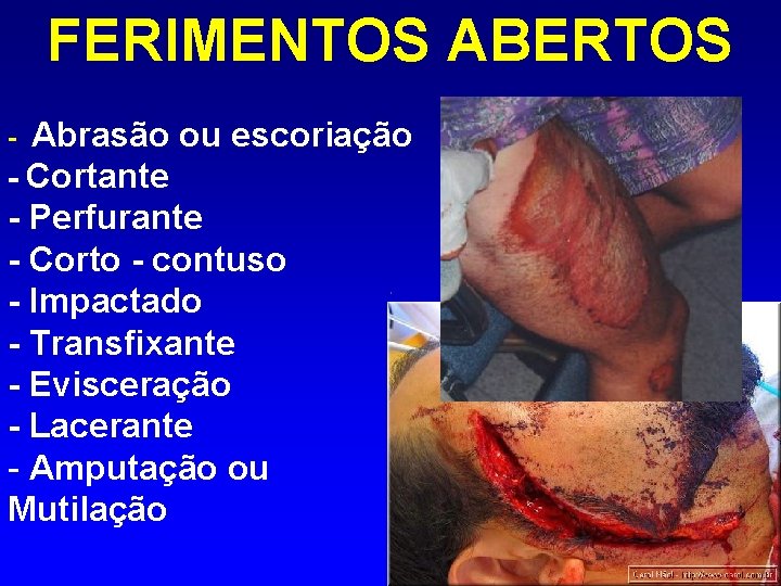 FERIMENTOS ABERTOS Abrasão ou escoriação - Cortante - Perfurante - Corto - contuso -